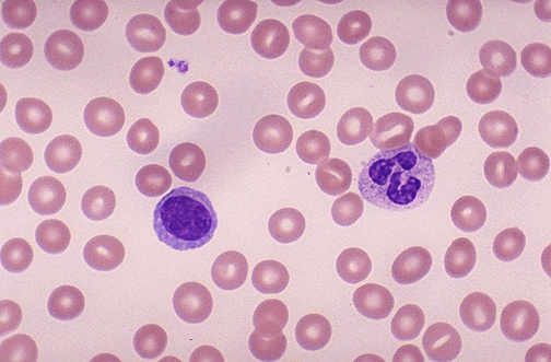 A peripheral blood smear showing red and white blood cells.